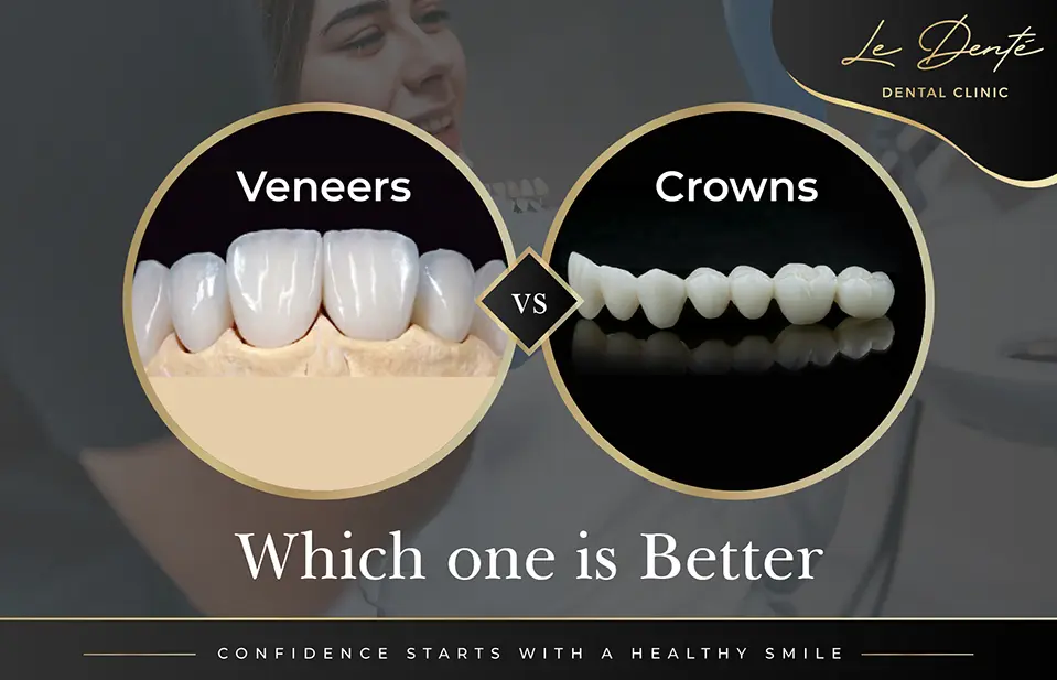 Veneers vs Crowns: Which One Is Better