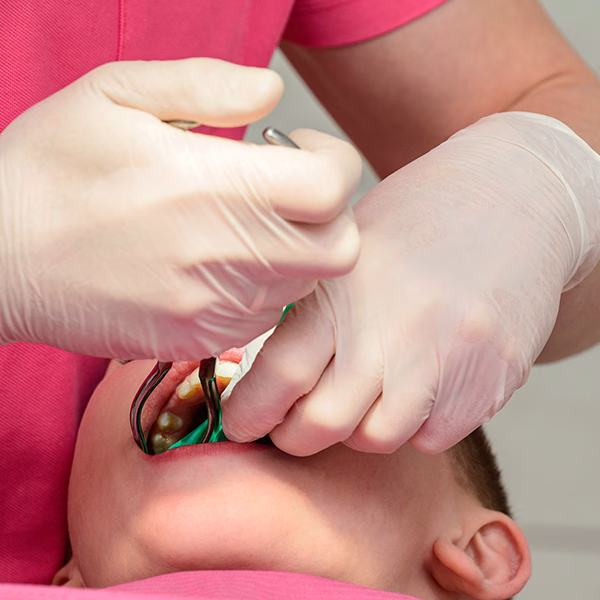 What is Root Canal Treatment?