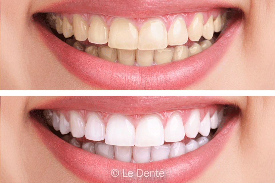 The Power of Teeth Whitening Treatment
