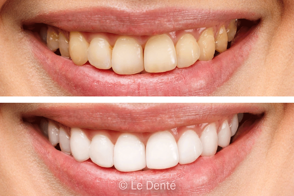 Teeth Whitening Treatment