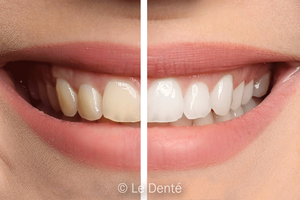 Before & After Transformations Teeth Whitening