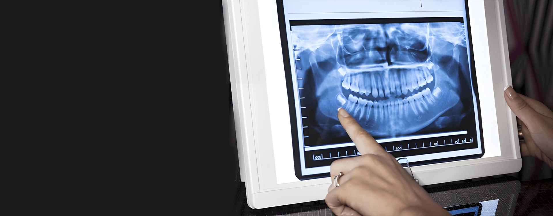 OPG Orthopantomogram