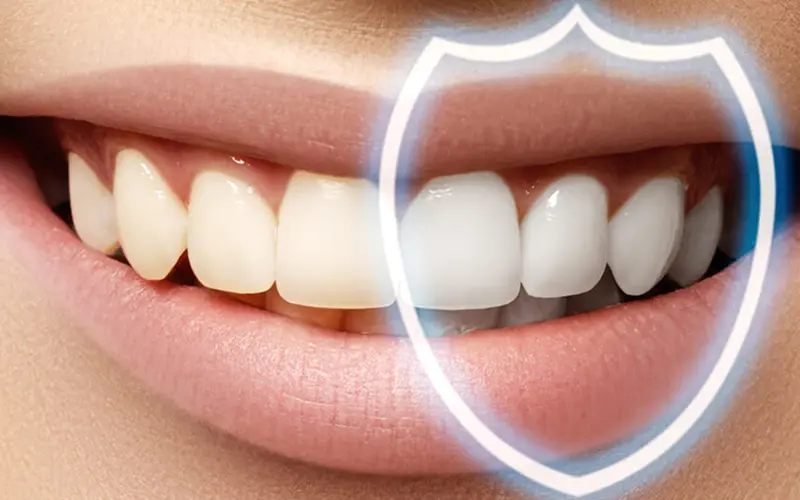 Caring for Composite Bonding