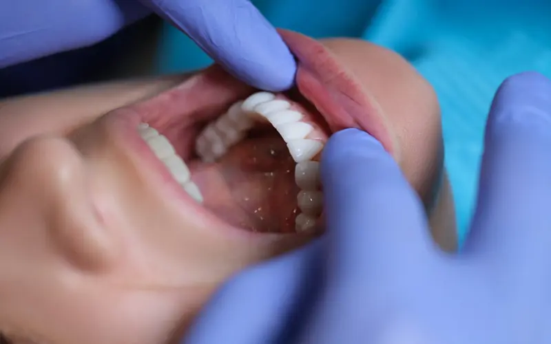Caring for Your Veneers