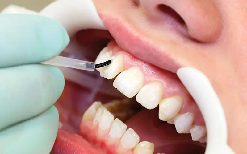 Composite Bonding vs Veneers