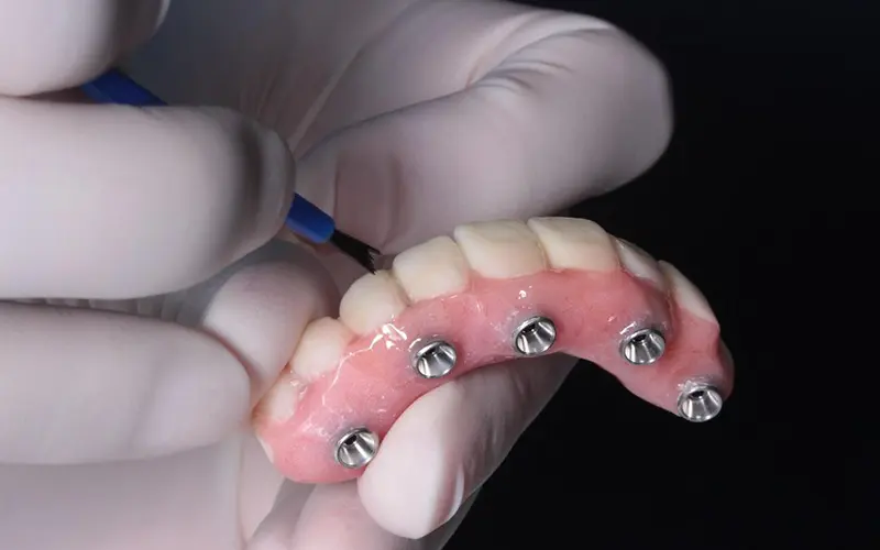 Implant-Supported Dentures