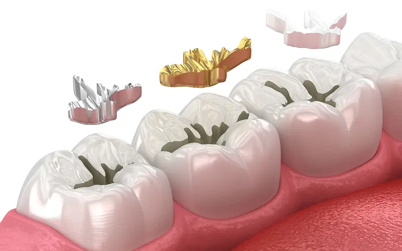Dental Filling Materials