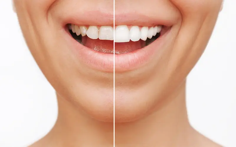 Porcelain vs Ceramic Veneers 