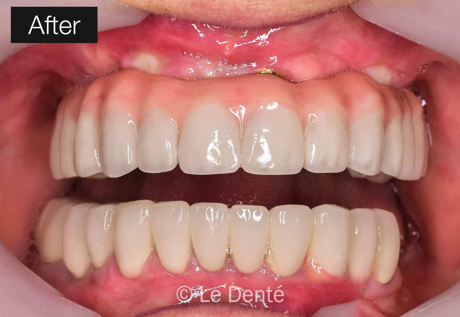 Transforming Smiles - Best dental implant