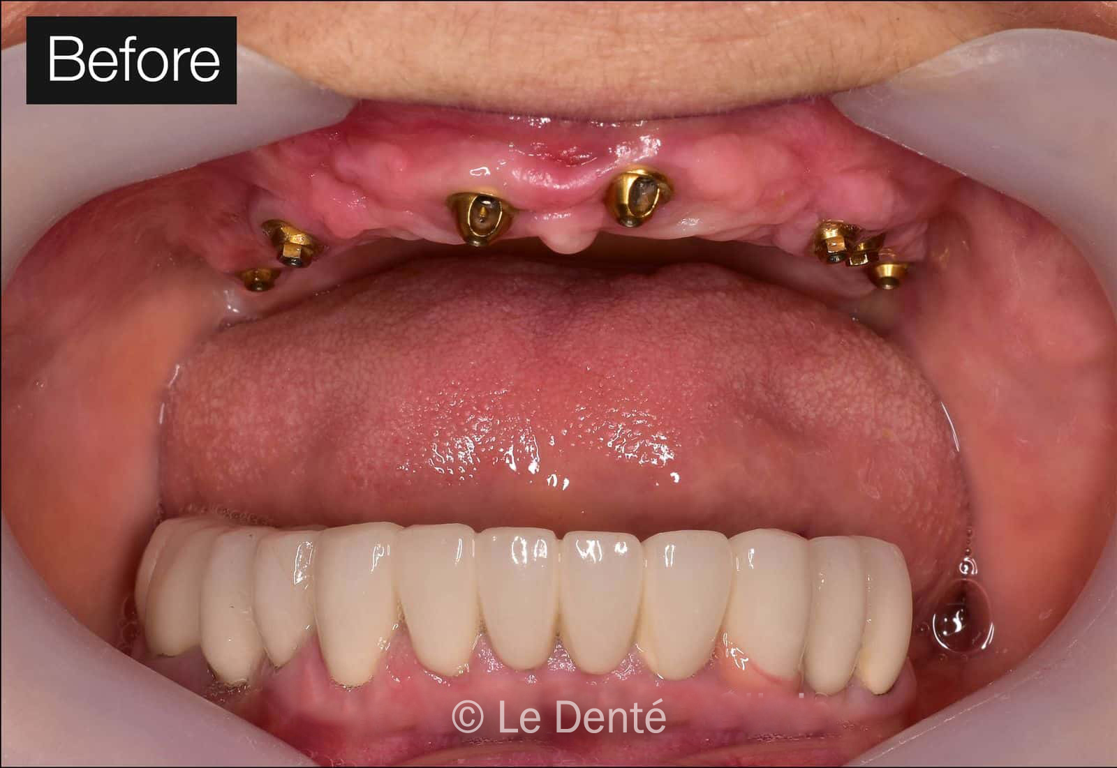 Transforming Smiles - Best dental implant