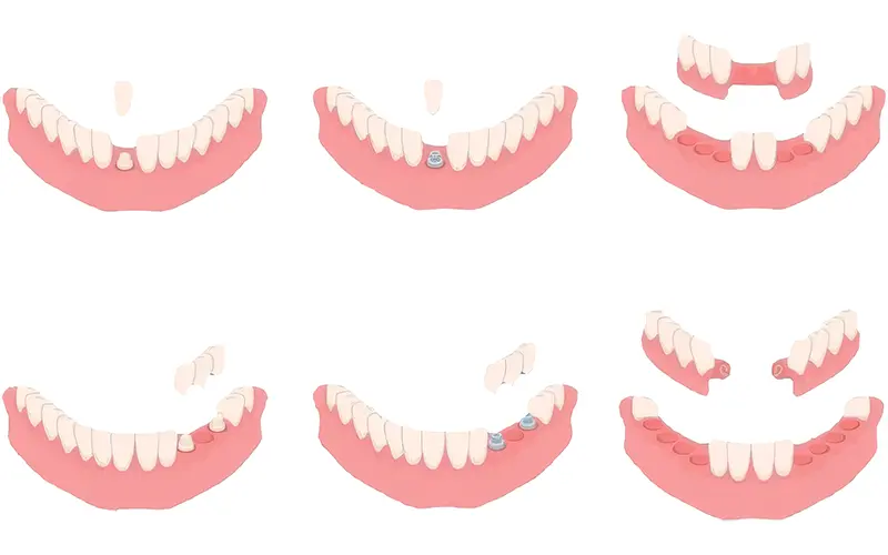 Different Types of Dentures