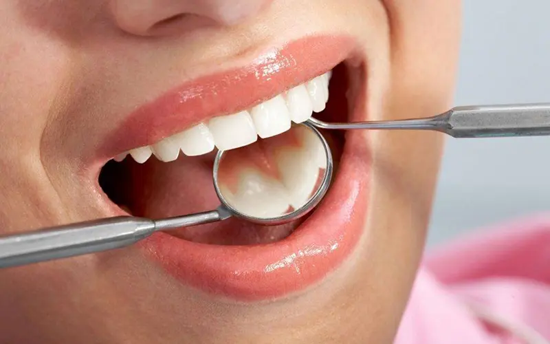 What Are Dental Fillings
