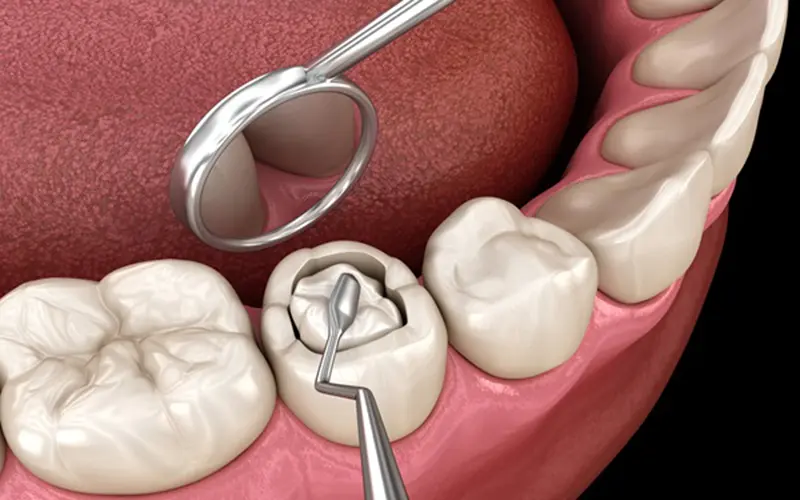 Why Choose Inlays and Onlays Over Traditional Fillings