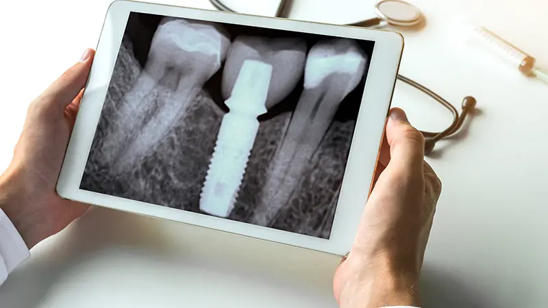 Dental Implants