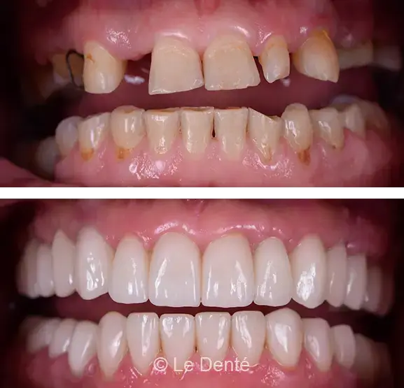 Full Mouth Rehabilitation
