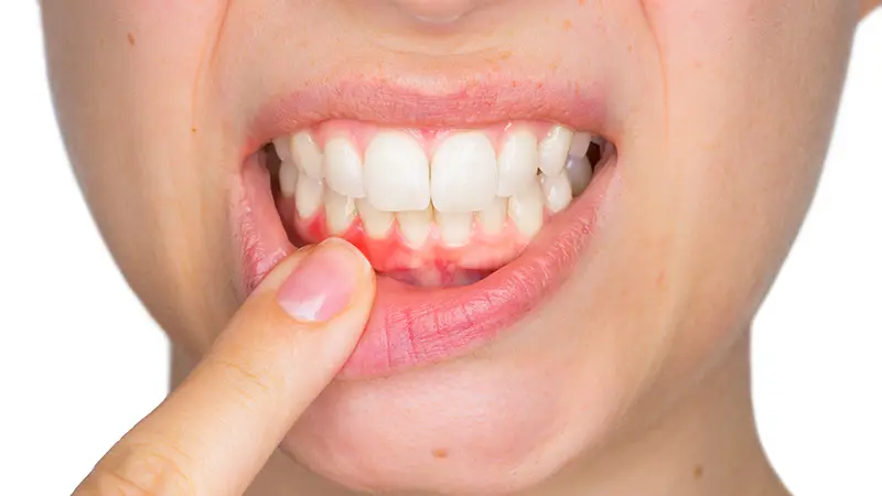 Gum Treatment