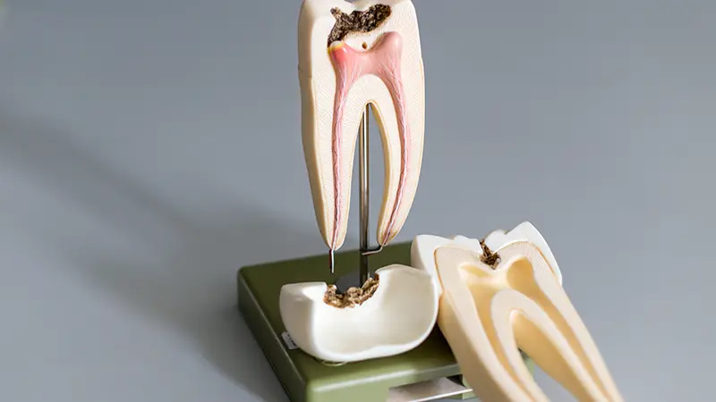 Root Canal Treatment