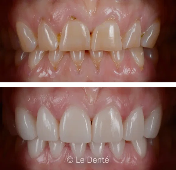 Smile makeover treatment result 1