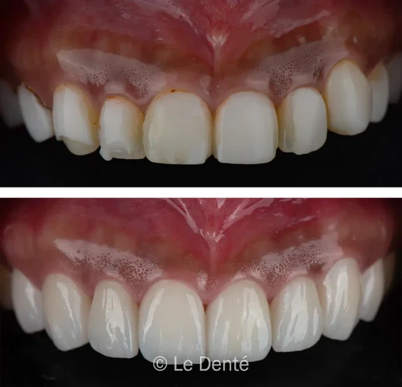 Smile makeover treatment result 2