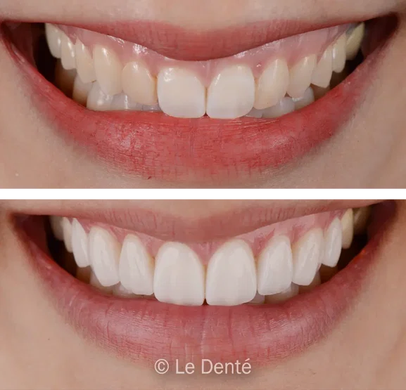 Smile makeover treatment result 3