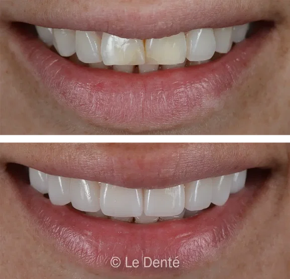 Smile makeover treatment result 4