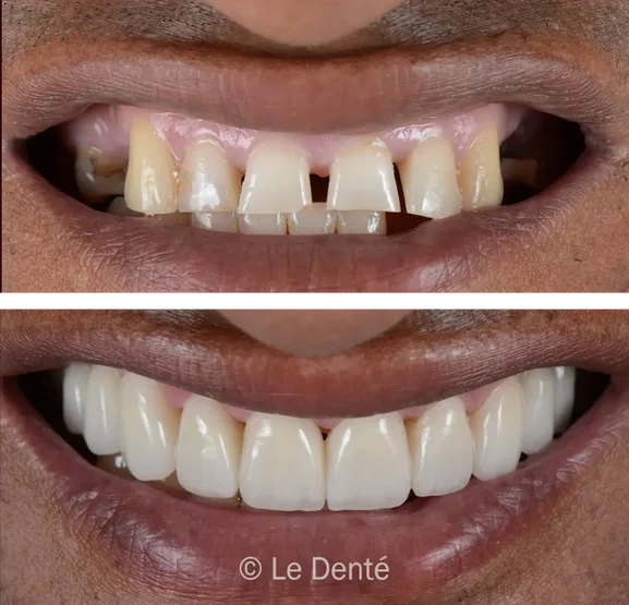 Smile makeover treatment result 5