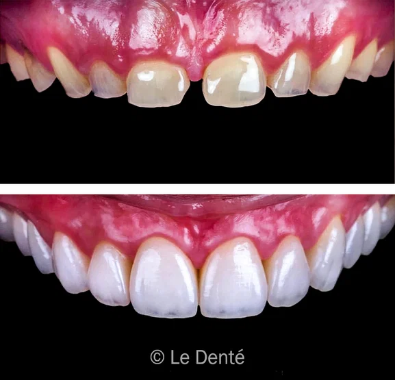 Smile makeover treatment result 6