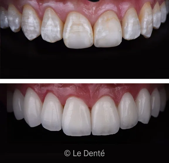 Smile makeover treatment result 7