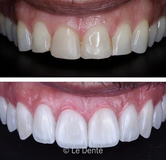 Smile makeover treatment result 8