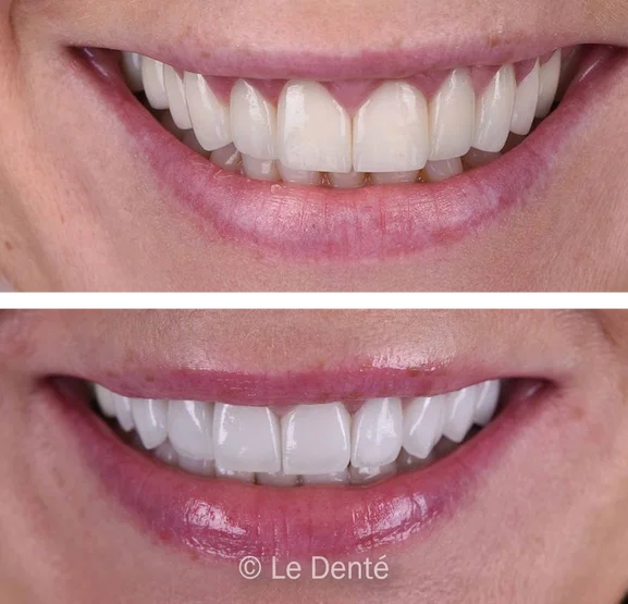 Smile makeover treatment result 9